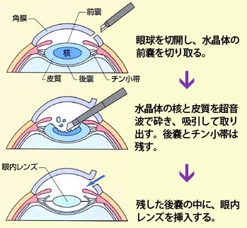 超音波水晶体乳化吸入術